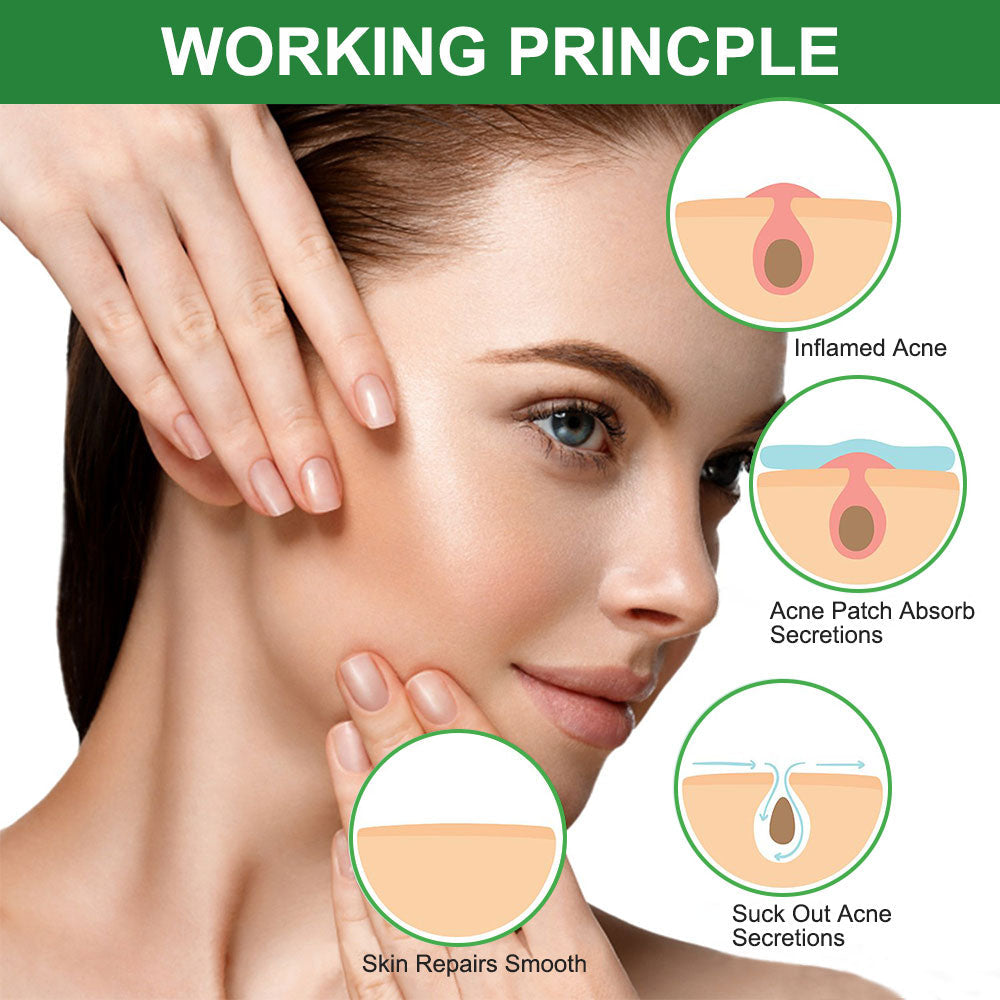 Pimple Patch: Hydrocolloid Acne Treatment