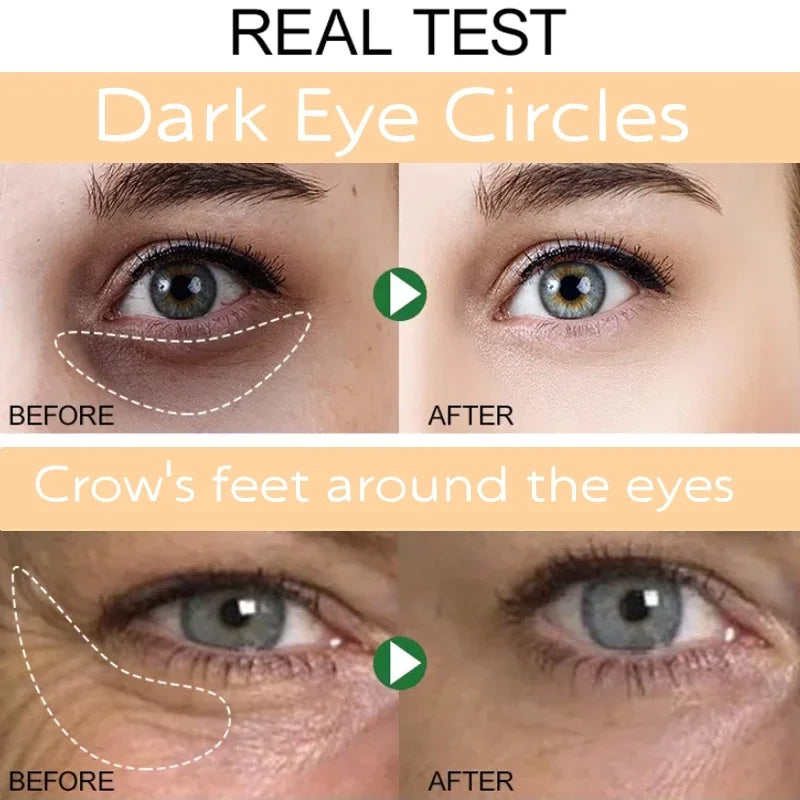 Eyelight - Eliminates Dark Circles & Puffy Eyes
