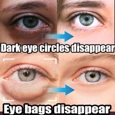 Eyelight - Eliminates Dark Circles & Puffy Eyes